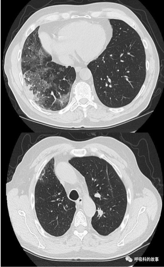62歲男性患者呼吸急促、乾咳3個月，卻被誤診3個月，這樣的事件你能接受嗎？