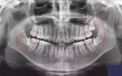 智齒到底要不要拔?有關“智齒”的問題,答案統統在這裡 智齒到底要不要拔?有關“智齒”的問題,答案統統在這裡