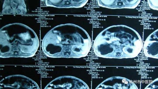 3歲“小葡萄”常哭鬧卻不長個，竟是從孃胎裡帶出來的毛病