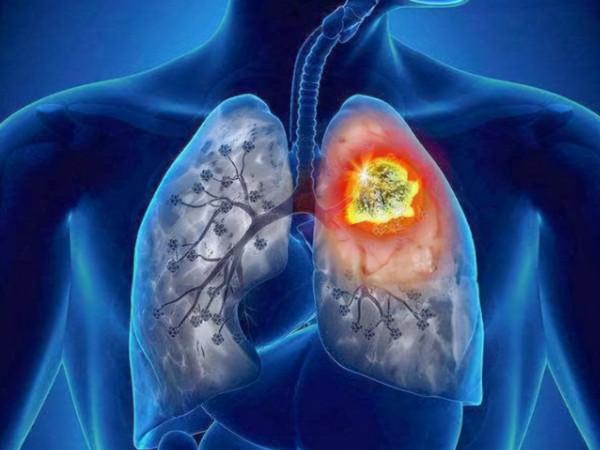 蘿蔔是結節的“加速劑”嗎？醫生：不想結節癌變，儘量少吃3物