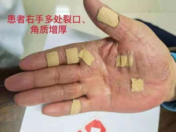 清洗過度,老人雙手竟染上“腳氣” 清洗過度,老人雙手竟染上“腳氣”