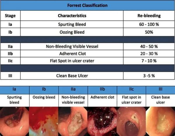 兒童急性蕁麻疹伴上消化道出血