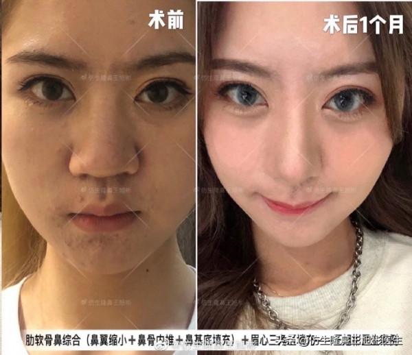 鼻頭縮小可以只“減脂”，不取自體軟骨做支架嗎？