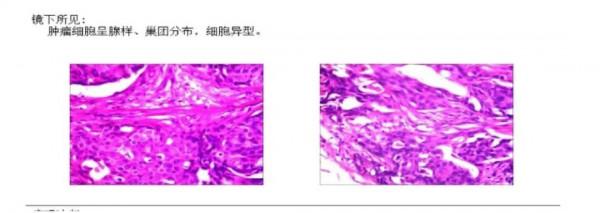 愈見未萊 | 赫帕雙靶新輔助治療HER-2+可手術乳腺癌患者，療效和安全性兼可得