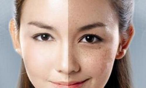 黃褐斑一化斑湯