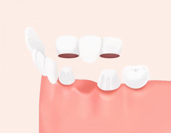 假牙的種類及價格，你知道嗎？