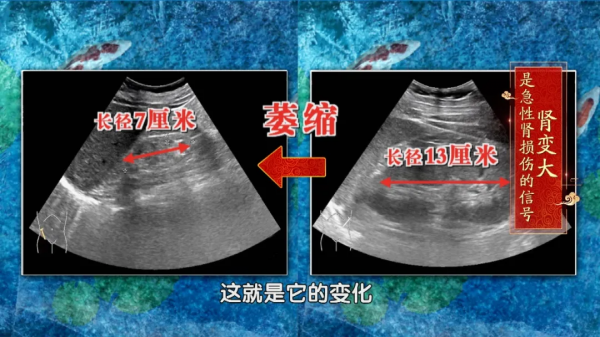 染髮可能會傷腎?這些因素也要小心!3項檢查助你提早發現腎損傷 染髮可能會傷腎?這些因素也要小心!3項檢查助你提早發現腎損傷