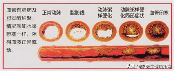 動脈硬化≠動脈粥樣硬化,學好軟化血管的3步驟,血流通暢少堵塞 動脈硬化≠動脈粥樣硬化,學好軟化血管的3步驟,血流通暢少堵塞
