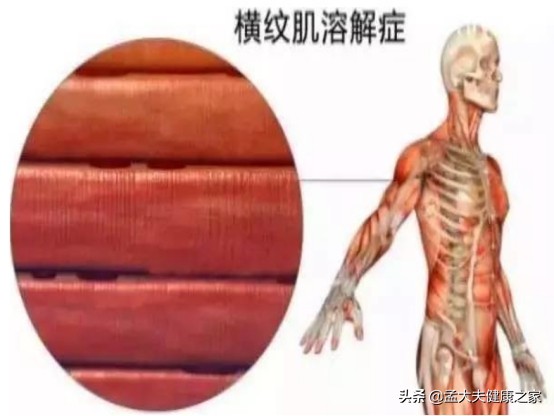 吃他汀的朋友注意出現3種情況，必須馬上停藥，需引起重視