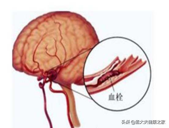 為何農村因腦梗死的人越來越多？醫生坦言：與3大因素有關