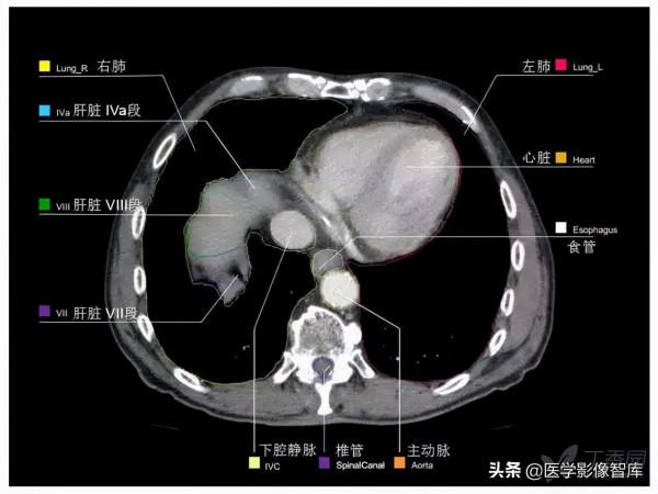 CT斷層解剖圖譜最全總結「推薦收藏」 CT斷層解剖圖譜最全總結「推薦收藏」