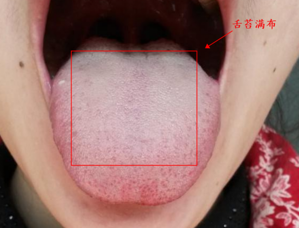 溼熱、寒溼、痰溼：病因不同、症狀不同、調理方法也不同