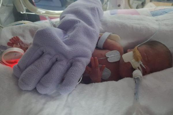 現實版拇指姑娘 出生時比手套還小 現在已經是一個堅強的小女孩