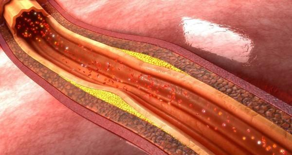 中年男子，頸動脈斑塊，吃了5年他汀，看看現在的檢查化驗結果