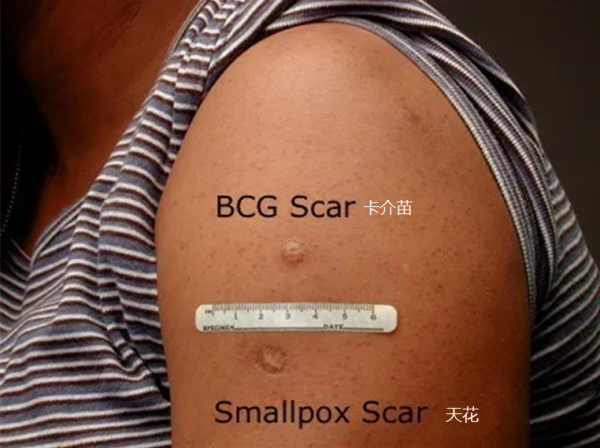 為什麼小時候接種疫苗後，胳膊上會留下小疤痕？你的身上有嗎？