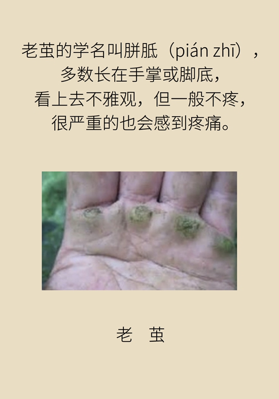 長了雞眼和老繭怎麼辦？這份防治指南請收好