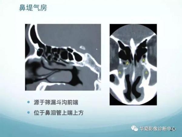 頭頸五官CT斷層解剖圖及常見病影像診斷