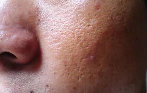 擠壓抓撓後，鼻子上擠出來白色條狀，是什麼東西？