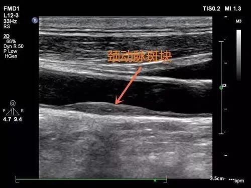 查出頸動脈斑塊,飲食該如何注意 查出頸動脈斑塊,飲食該如何注意