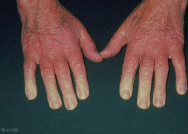 血脂升高，身體會出現這3個訊號