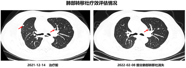 晚期HER2突變肺腺癌：後線吡咯替尼療效神奇