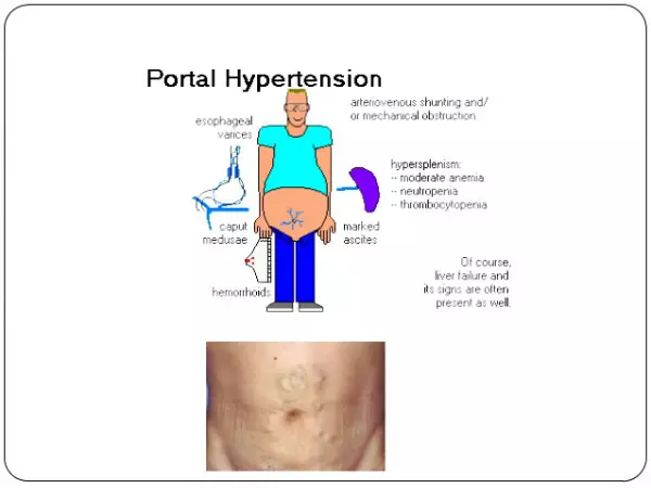 肝門靜脈的解剖與生理病理特點