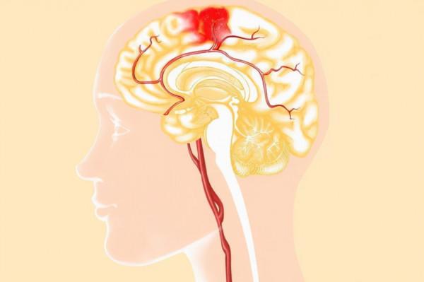 血壓高到多少才會發生腦出血?醫生給出參考值,建議心裡有數 血壓高到多少才會發生腦出血?醫生給出參考值,建議心裡有數