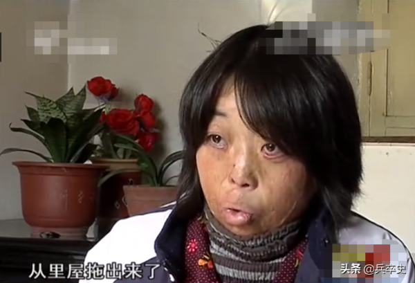 真實故事：山東女娃被開水燙成“鬼臉”，24歲結婚後又慘遭家暴