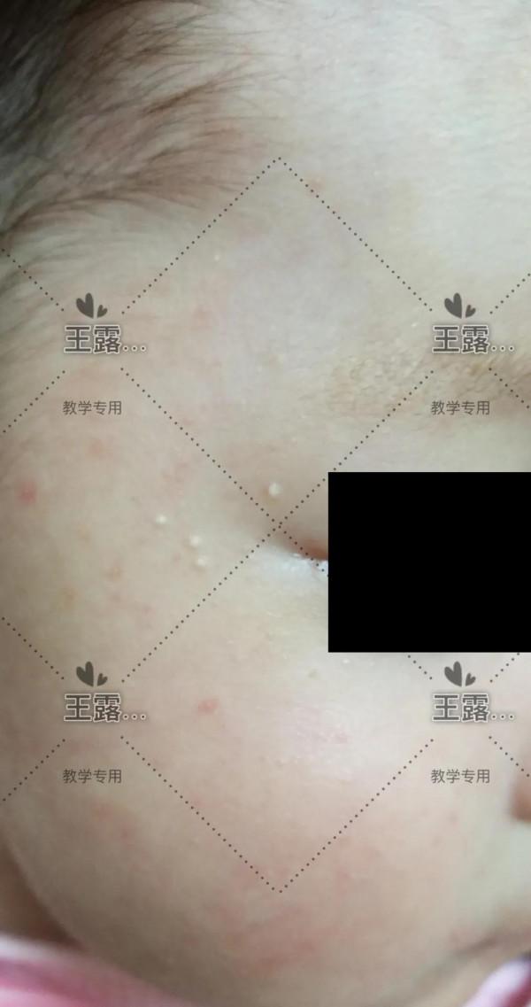 新生兒一過性面板病（上）