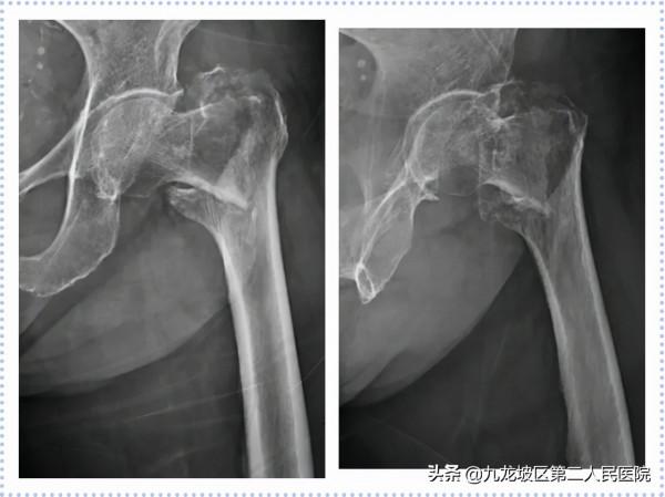 22張高畫質X線片!帶你看清胯骨骨折手術前後對比 22張高畫質X線片!帶你看清胯骨骨折手術前後對比