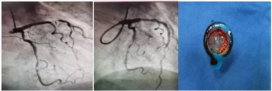 有介入無植入:北京老年醫院心內科成功實施冠脈內血栓抽吸術救治急性心梗患者 有介入無植入:北京老年醫院心內科成功實施冠脈內血栓抽吸術救治急性心梗患者
