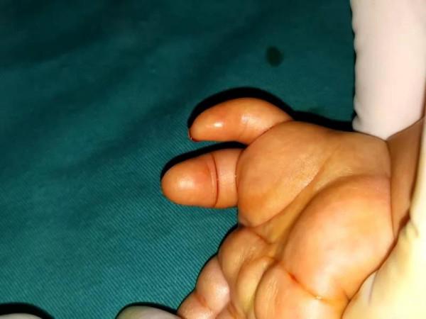 大排畸能檢查出手部畸形的寶寶嗎？