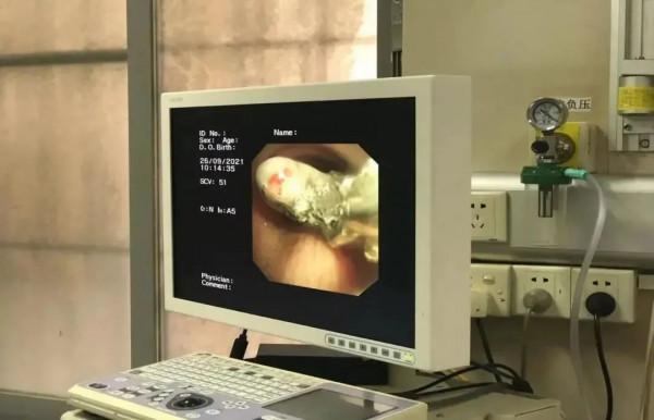 一頓飯，讓大叔咳嗽、胸痛兩年，檢查發現左側氣管內還有個閃閃發光的東西...