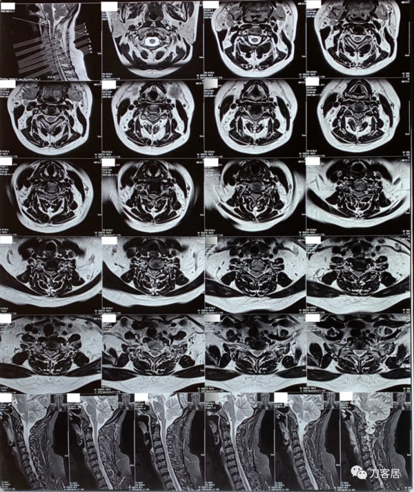 查體的重要性，一直按照腰椎間盤突出症治療的脊髓型頸椎病