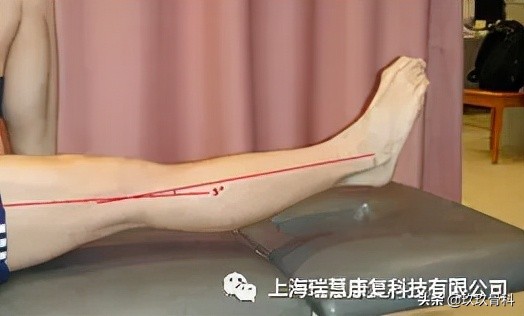 膝關節術後彎的很好，卻伸不直了？你要考慮這幾點