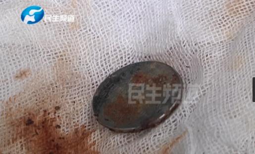 鄭州一歲寶寶誤吞異物,食道被腐蝕穿孔!家長們一定要多注意此類物品 鄭州一歲寶寶誤吞異物,食道被腐蝕穿孔!家長們一定要多注意此類物品