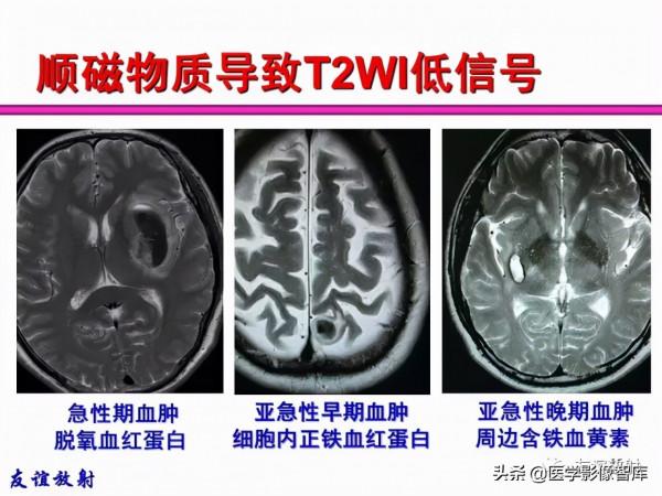 臨床MRI訊號分析基礎：常規序列及DWI序列