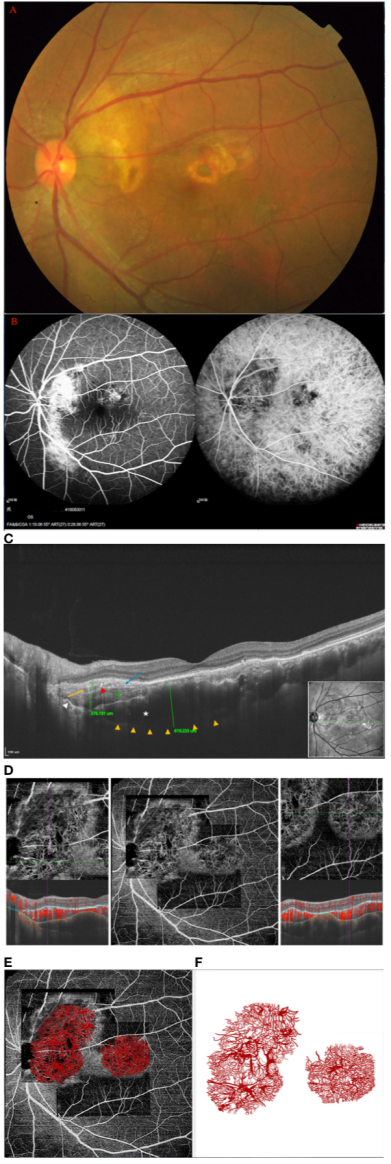 魏文斌教授團隊：海扇狀血管網路，脈絡膜骨瘤腫瘤血管系統新解