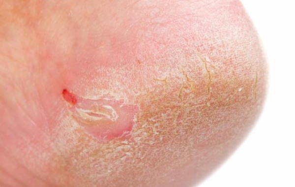 腳後跟乾裂，小腿長&OpenCurlyDoubleQuote;魚鱗&rdquo;，或並非是面板缺水所致