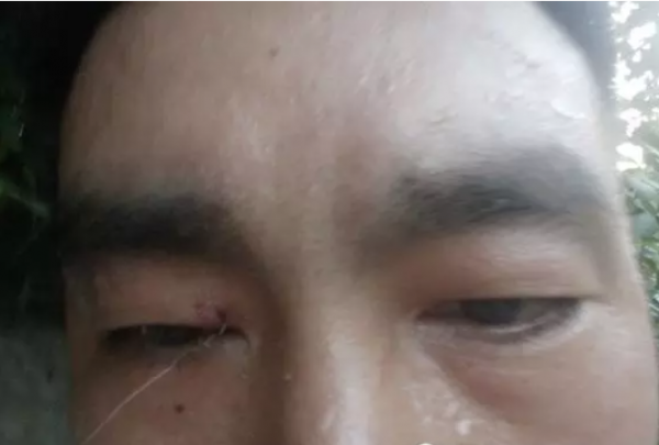 盤點釣魚人各種花式釣自己，看著就很疼！預防和處理方法分享