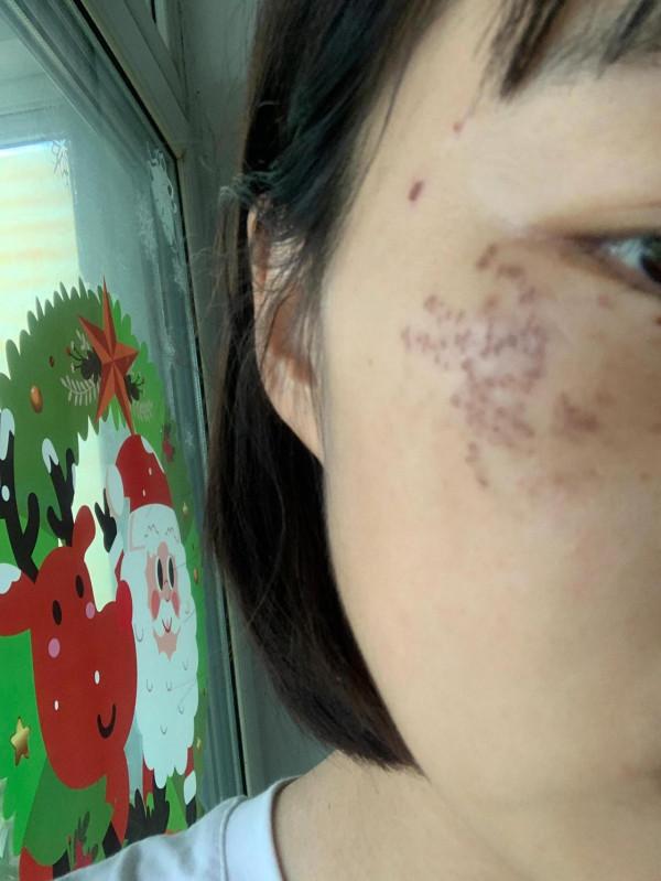 鐳射祛除褐青痣（顴骨母斑）