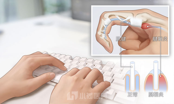 手腕腱鞘炎是哪裡疼？