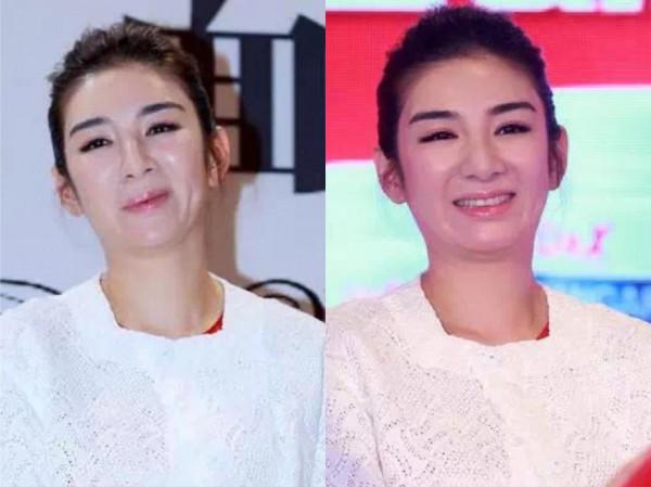 臉腫，嘴歪，笑不出來，整容後的&quot&semi;矽膠臉&quot&semi;把這9位好演員，害慘了