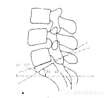 骶椎腰化/腰椎骶化、腰椎滑脫、腰肌勞損，簡單易懂圖解