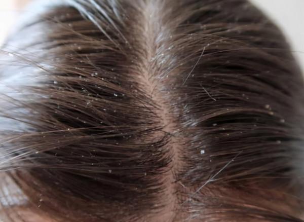 洗頭時加幾粒“阿司匹林”，堅持三個月，頭髮會發生什麼變化？