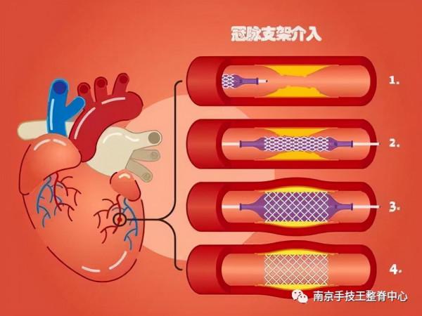“心臟裝起搏器與裝支架”的患者能進行整脊調理嗎？