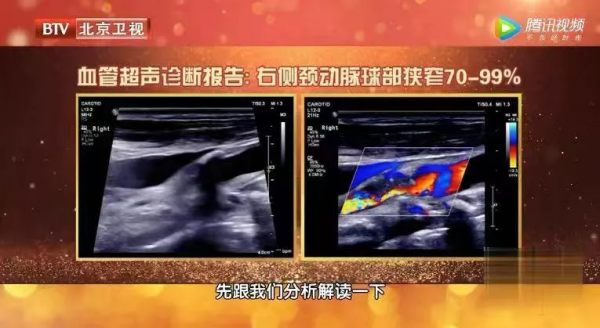 2年沒複查,息肉變成癌!B超報告裡出現“這些字眼”可能危險了 2年沒複查,息肉變成癌!B超報告裡出現“這些字眼”可能危險了