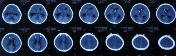 顱內生殖細胞瘤切除術後腦積水仍反覆,意識模糊,左側肢體偏癱 顱內生殖細胞瘤切除術後腦積水仍反覆,意識模糊,左側肢體偏癱