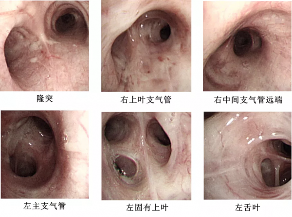 中年男性反覆發熱、咳嗽、咳痰,肺部陰影緣何而生? 中年男性反覆發熱、咳嗽、咳痰,肺部陰影緣何而生?