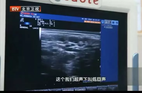 2年沒複查,息肉變成癌!B超報告裡出現“這些字眼”可能危險了 2年沒複查,息肉變成癌!B超報告裡出現“這些字眼”可能危險了